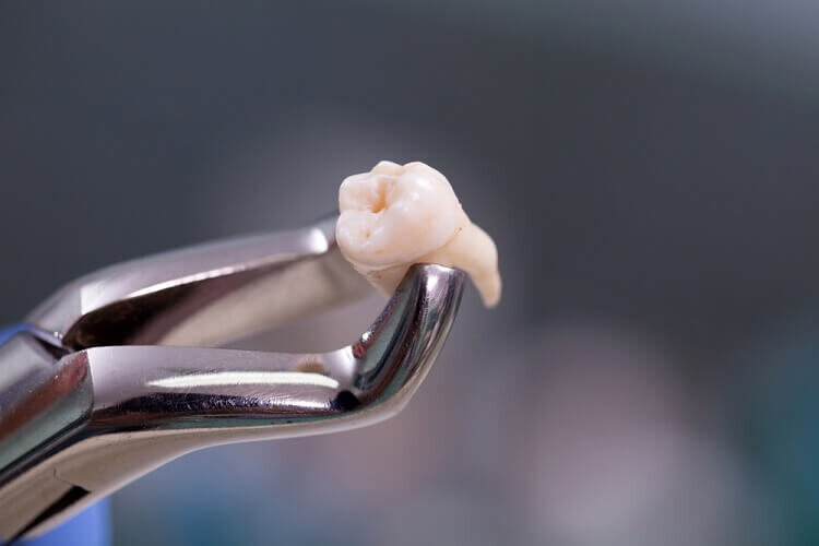 Extractions (including wisdom teeth)